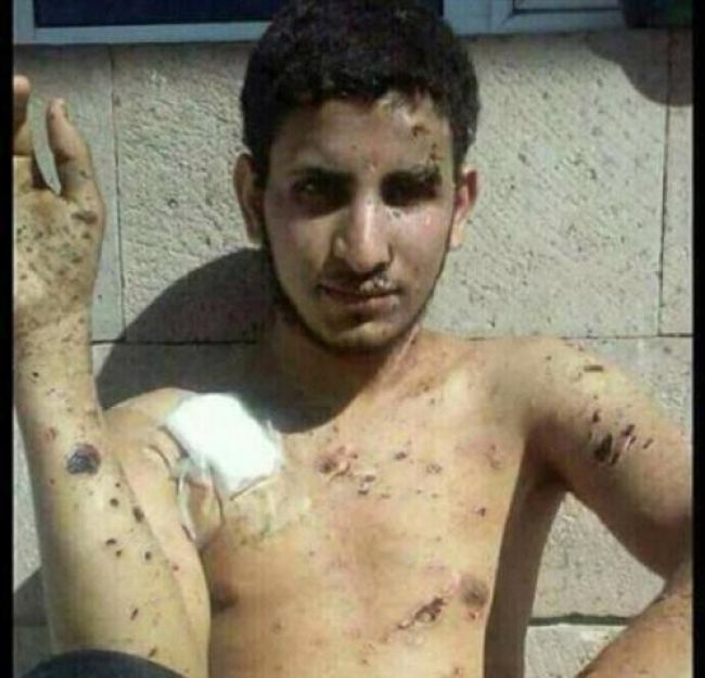 الضالع: آثار تعذيب وحشي تعرض له شاب في سجون الحوثي (صورة) .